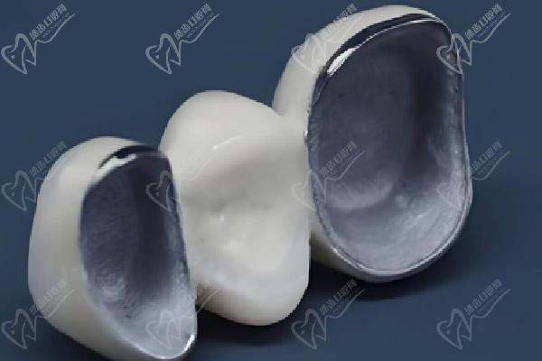一體冠與橋架修復方式的對比