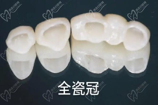 橋架材質(zhì)有哪些分類？純鈦橋架更值得選嗎